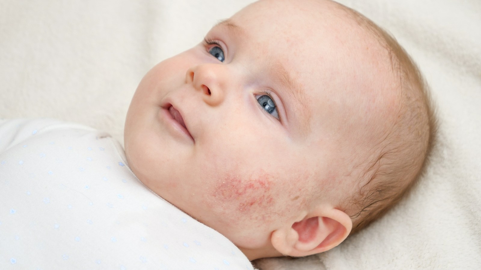 bebé con mejillas enrojecidas por un rash